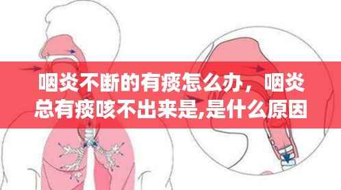 咽炎不断的有痰怎么办,咽炎总有痰咳不出来是,是什么原因