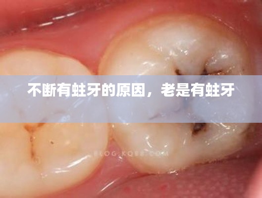 不断有蛀牙的原因,老是有蛀牙