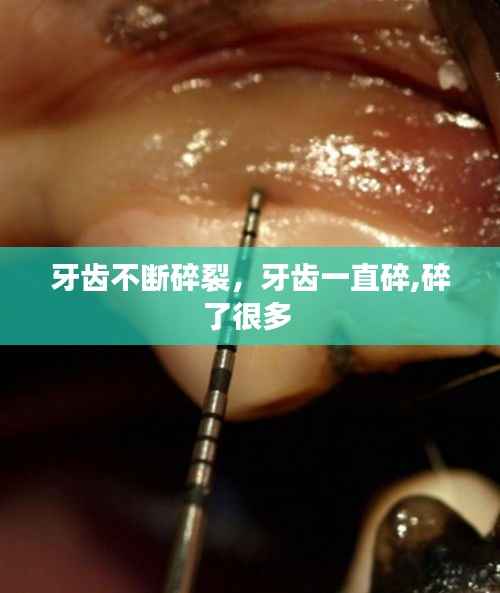 牙齿不断碎裂,牙齿一直碎,碎了很多