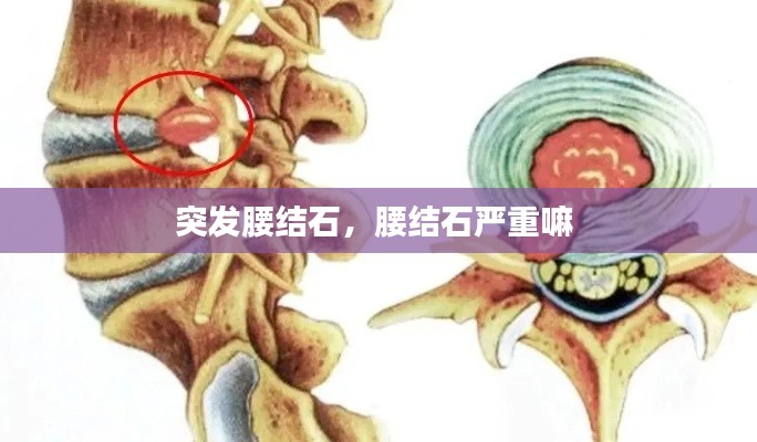 突发腰结石,腰结石严重嘛